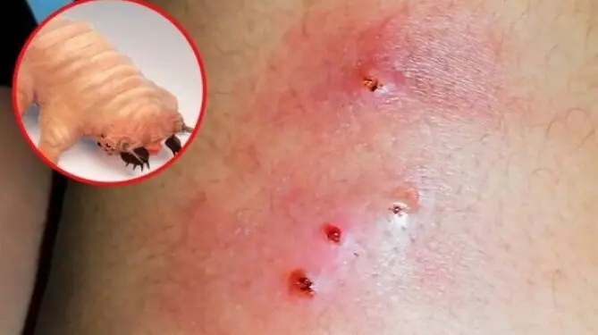 El paciente de miasis de Copala tiene padecimientos crónicos como diabetes y alcoholismo, pero está estable